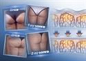 Ayşestetik Selülit Tedavisi Selülit Giderici COLD CELLULITE